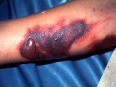 Δάγκειος πυρετός: Προσοχή σε όσους ταξιδεύουν στο εξωτερικό