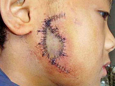 Δασκάλα έσκισε το μάγουλο μαθητή της