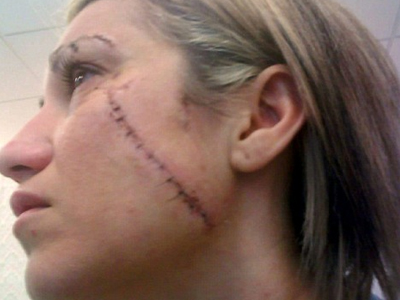 Χαράκωσαν τραγουδίστρια στο πρόσωπο