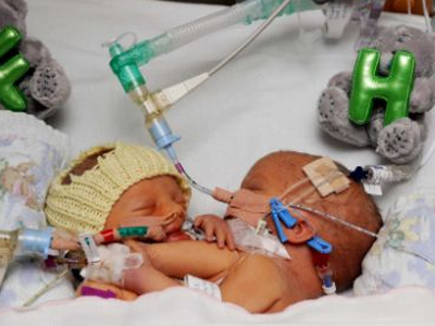 Θα γεννήσει δικέφαλα σιαμαία