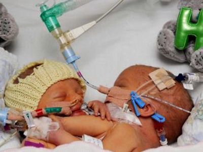 Απόψε θα χωριστούν τα σιαμαία