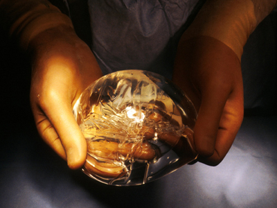 Παραλίγο φονιάς για τη σιλικόνη της κοπέλας του