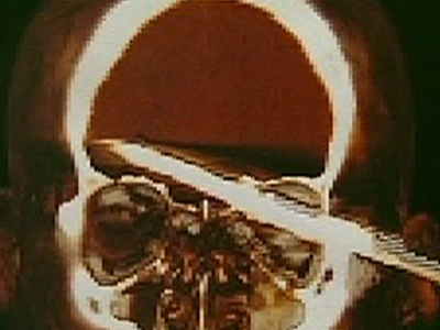 Καμάκι διαπέρασε το κεφάλι του και επέζησε