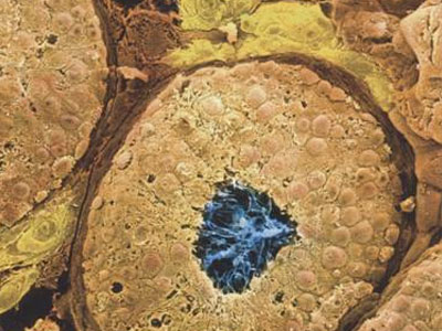 Θρομβοφιλία: Μία ύπουλη απειλή