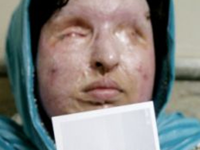 Την τύφλωσε με οξύ για να μην την παντρευτεί κανένας άλλος