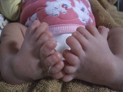 Γεννήθηκε μωρό με 16 δάχτυλα στα πόδια