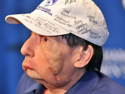 Το πρόσωπο του 2ου ανθρώπου που έκανε μεταμόσχευση προσώπου