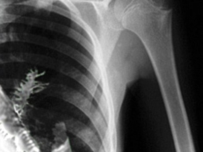 Φύτρωσε… δέντρο στον πνεύμονά του