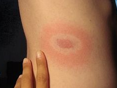 Φονικό τσιμπούρι στη χώρα μας