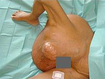 Αφαίρεσαν όγκο 18 κιλών από γυναίκα