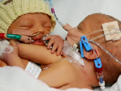 Κατέληξε και το δεύτερο σιαμαίο κορίτσι