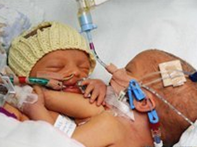 Τα σιαμαία που γέννησε 18χρονη