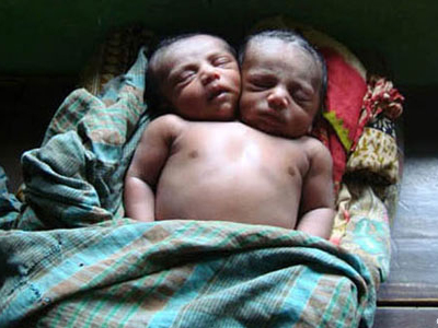 “Έσβησε” το μωρό με τα δύο κεφάλια