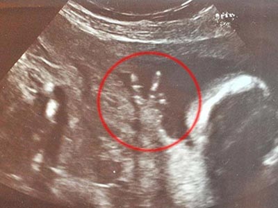 Άγριο μωρό… πριν καν γεννηθεί