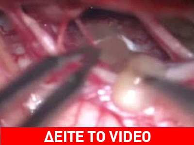 Της έβγαλαν σκουλήκι από τον εγκέφαλο