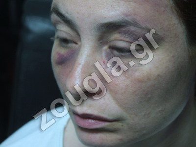 Καταγγέλλει άγριο ξυλοδαρμό από αστυνομικούς