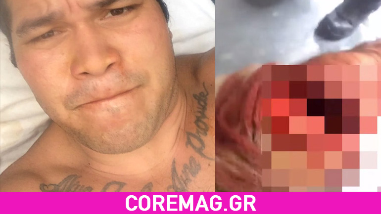 Καρχαρίας του έφαγε το πόδι (Προσοχή σκληρές εικόνες)