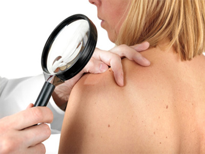 Δωρεάν εξετάσεις για μελάνωμα