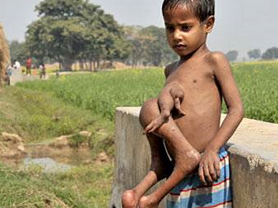 Επτάχρονος κουβαλά μέσα του τον δίδυμο αδερφό του