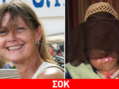 ΣΟΚ: Θύμα επίθεσης χιμπατζή αποκαλύπτεται