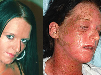 Κάηκε από βαφή μαλλιών