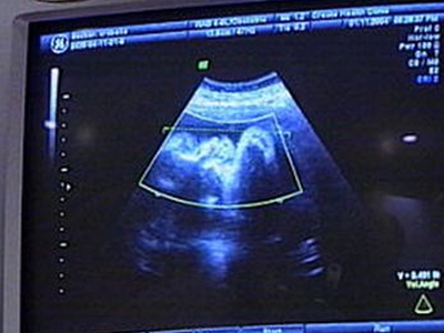 Η αντισύλληψη σύμμαχος στην μείωση των αμβλώσεων