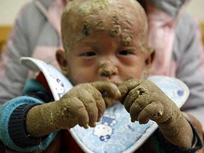 Μωρό με δέρμα… ψαριού!