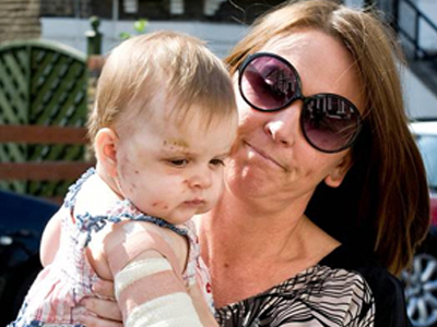 Αναρρώνει το μωρό – θύμα επίθεσης αλεπούς