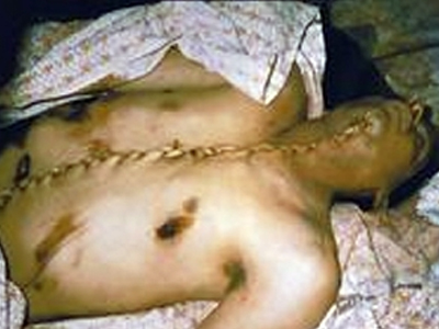 To εμπόριο οργάνων “αγκάθι” στις σχέσεις Σουηδίας – Ισραήλ