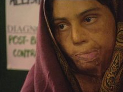 Πακιστάν: Συλλήψεις για την επίθεση με οξύ