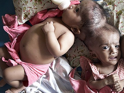 Αγωνία για σιαμαία κορίτσια στην Μελβούρνη