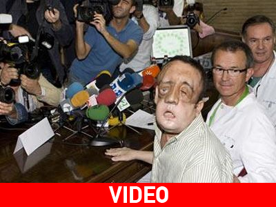 «Ευγνώμων» ο άνθρωπος που έκανε μερική μεταμόσχευση προσώπου