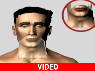 Video από την ολική μεταμόσχευση προσώπου