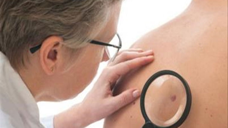 Δωρεάν εξετάσεις για τον καρκίνο του δέρματος