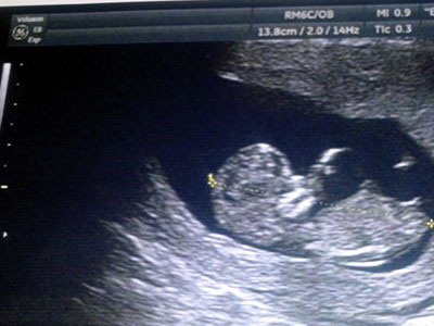 Η σημασία του υπερηχογραφήματος στην ανάπτυξη δεσμού ανάμεσα στον πατέρα και το παιδί