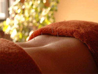 Η τέχνη του βελονισμού