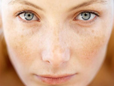 Διχρωμίες ή κηλίδες; Το μυστικό βρίσκεται στην κουζίνα σου!