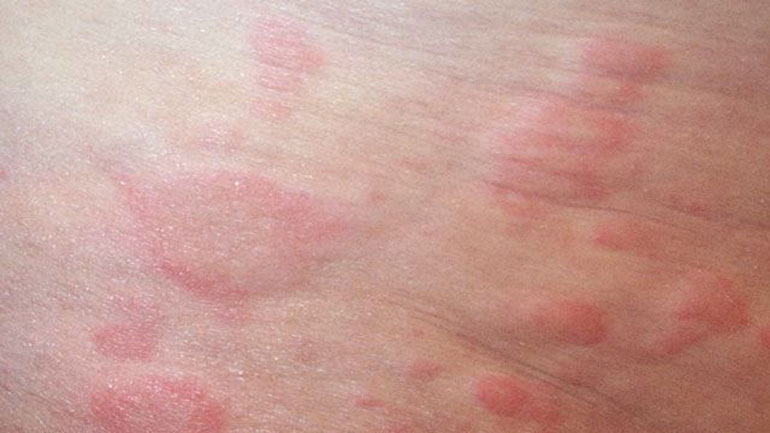 Συστηματικός Ερυθηματώδης Λύκος: Η νόσος που «προτιμά» τις γυναίκες