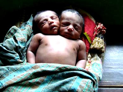 «Έσβησαν» από καρδιακή ανεπάρκεια τα σιαμαία