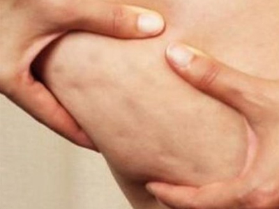 Διατροφή και Κυτταρίτιδα