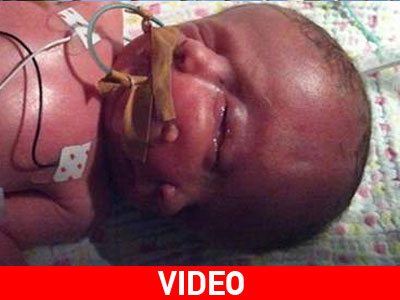 Κατέληξαν τα σιαμαία δίδυμα που μοιράζονταν ένα σώμα αλλά είχαν χωριστά πρόσωπα