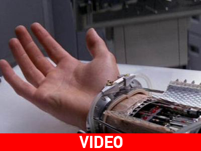 Βιονικό χέρι δίνει εκ νέου σε ασθενή την αίσθηση της αφής