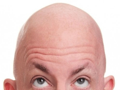 Πιο κοντά στη λύση για τη φαλάκρα