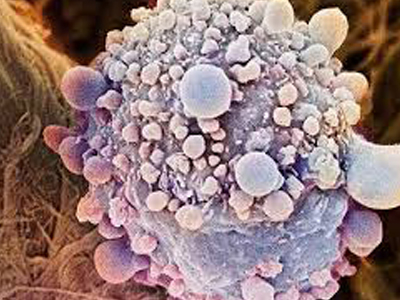 Νέα εξέταση ανιχνεύει τον καρκίνο σε λίγες ώρες