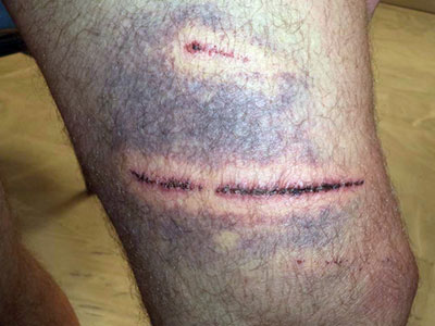 Τρίκαλα: Σκύλος έστειλε στο νοσοκομείο εκπαιδευτικό