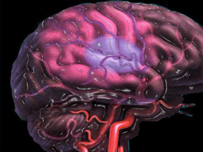 Μειώθηκαν οι πρόωροι θάνατοι από εγκεφαλικό