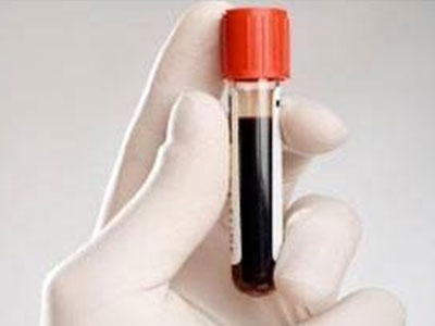 Τεστ αίματος προβλέπει το Αλτσχάιμερ