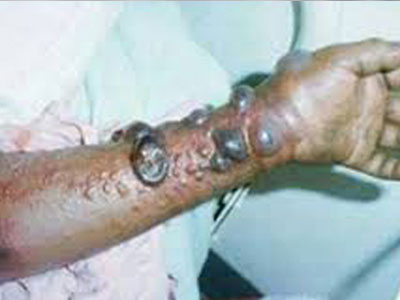 Σιέρα Λεόνε: Ανακοινώθηκε ο πρώτος θάνατος από Έμπολα 2