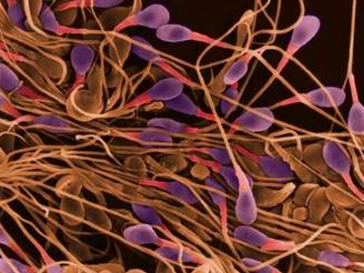 Επηρεάζει η υδροκήλη το σπέρμα;