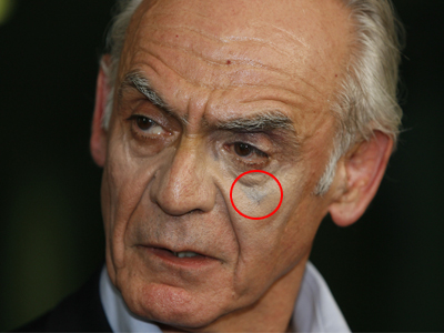 Τι έχει στο μάγουλο ο Τσοχατζόπουλος;